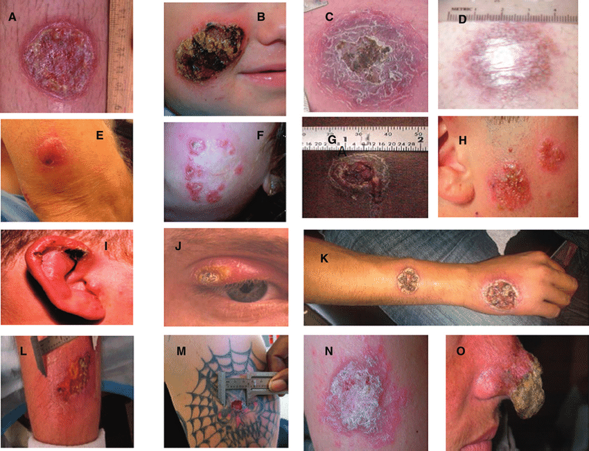 Clinical photographs of cutaneous leishmaniasis.